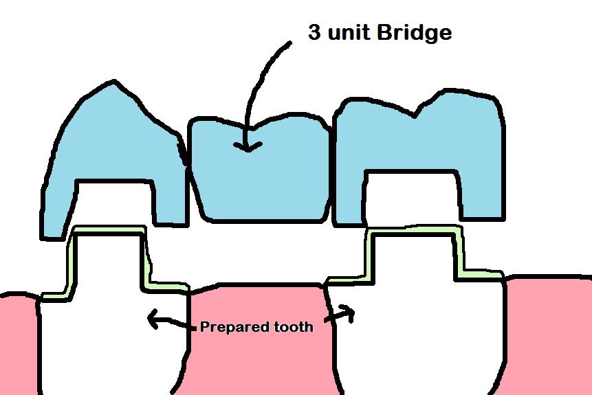 Dental Bridge diagram