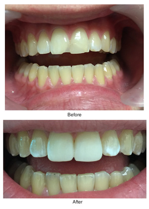 composite-bonding-before-after-vertical