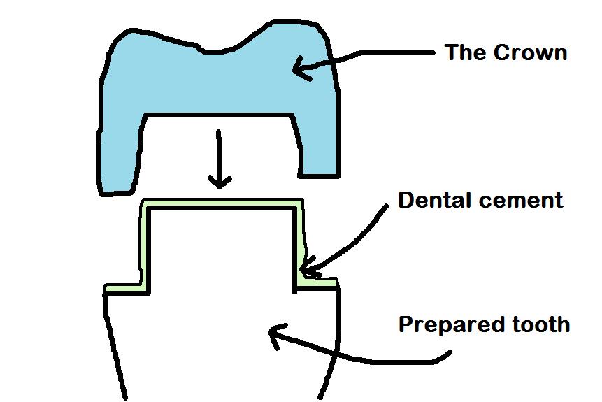 Dental crown diagram