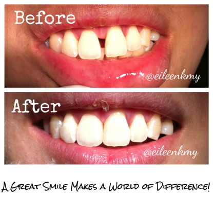 COmposite bondings veneers dentistsnearby