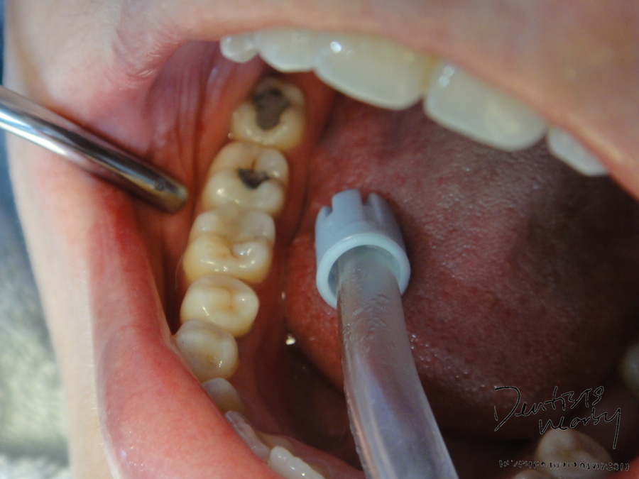 after posterior composite dentistsnearby