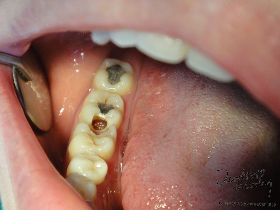 before composite posterior dentistsnearbyJPG
