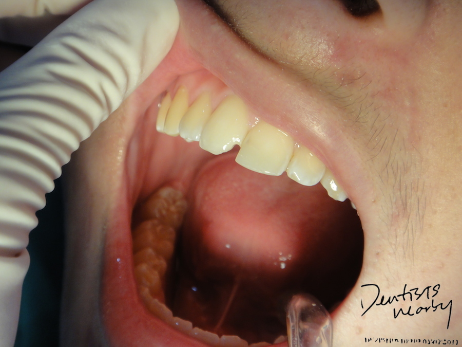 fractured incisor dentistsnearby