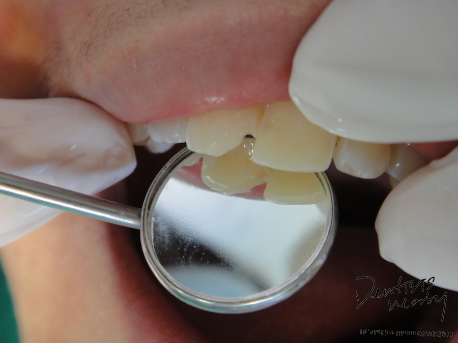 fractured incisor dentistsnearby1