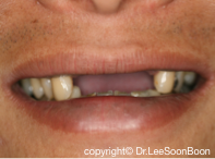 dental-implant-lee-soon-boon-dentistsnearby1
