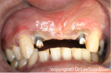 dental-implant-lee-soon-boon-dentistsnearby4