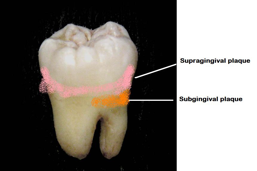 dental plaque ( Supragingival or Subgingival ) 