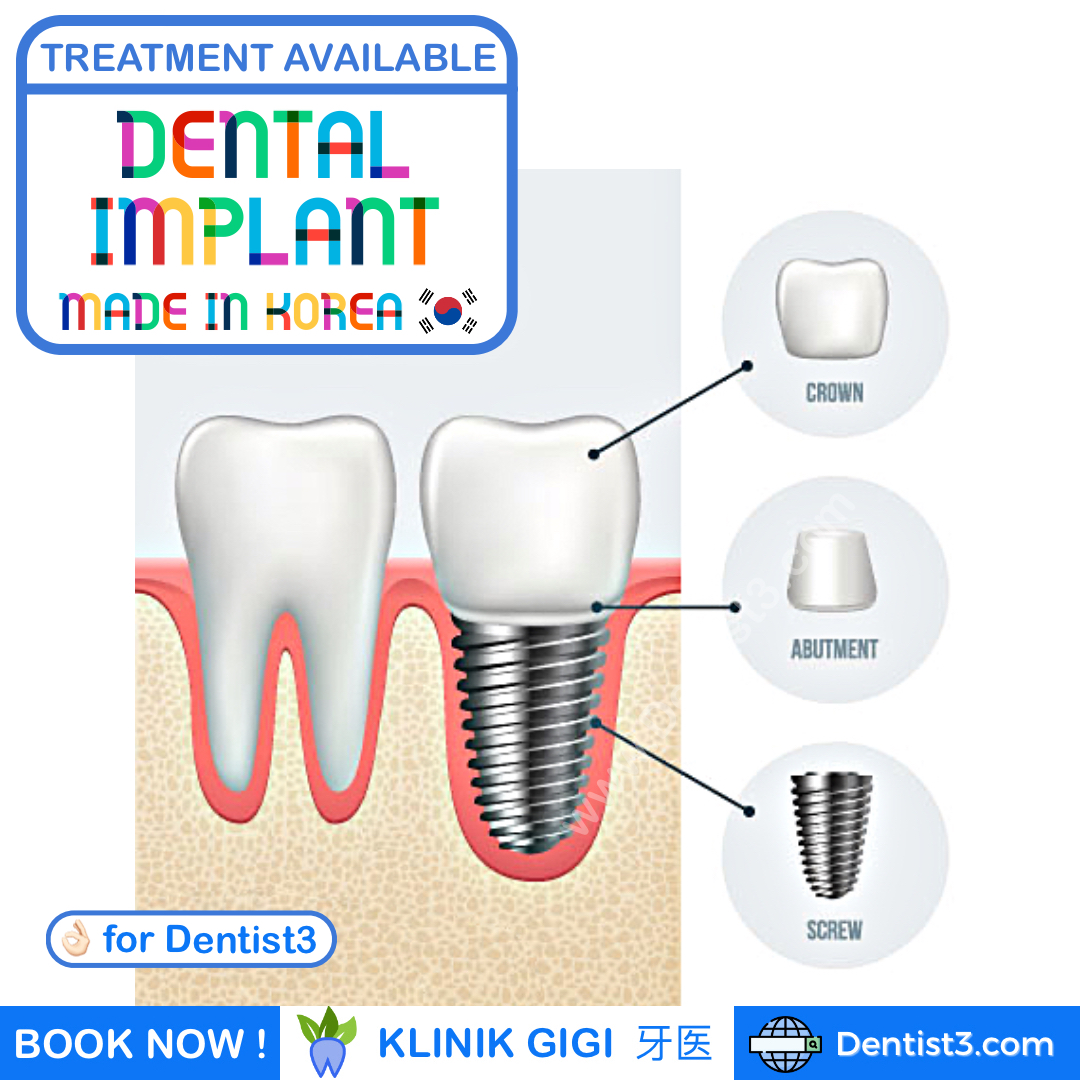 dental-implant-malaysia-1