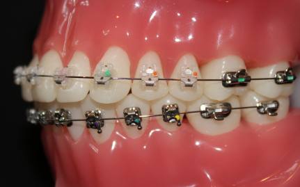 dentist3-braces