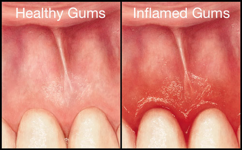 Healthy-vs-inflamed-gums-dentistsnearby