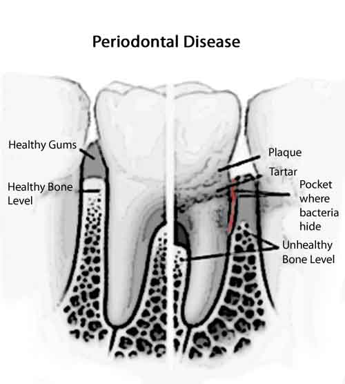 periodontal-disease-diagram-dentistsnearby