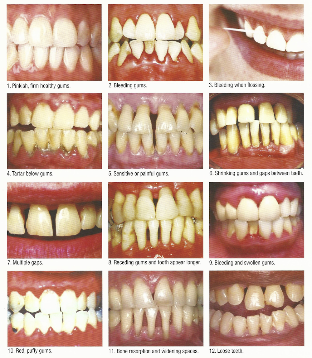 gums-gingiva-healthy-pathology-dentistsnearby