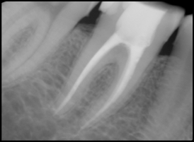 root canal treated xray