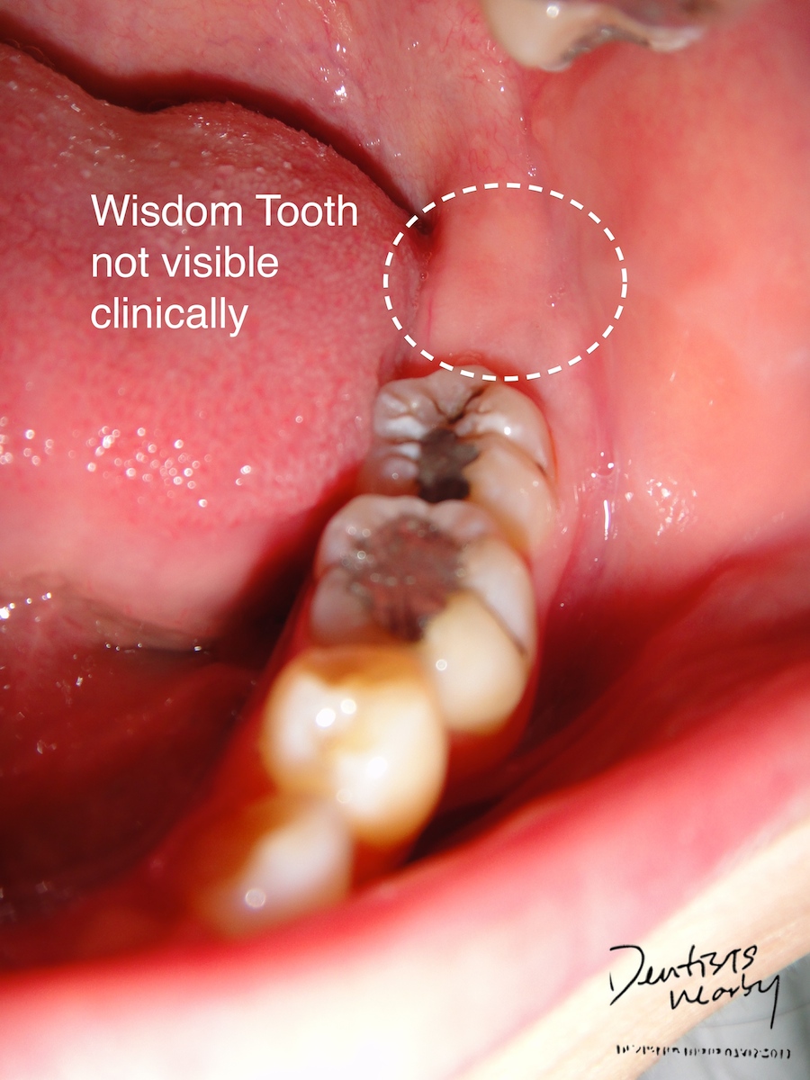 Wisdom Teeth Stitches Fall Out