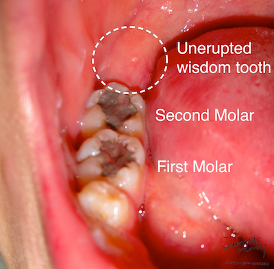 wisdom teeth removal bleeding won't stop