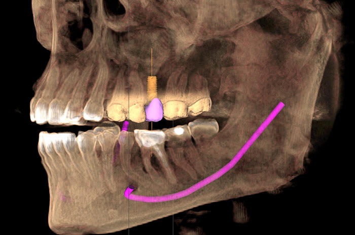 CBCT-with-dental-implant-dentistsnearby