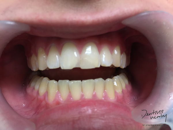 Jaya-dental-surgery-composite-bonding-dental-treatment1