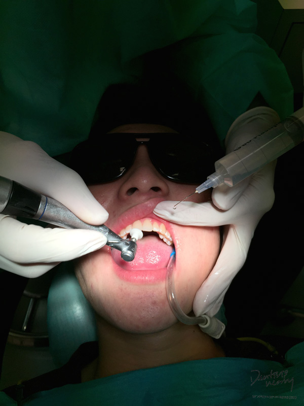 Jaya-dental-surgery-composite-bonding-dental-treatment10