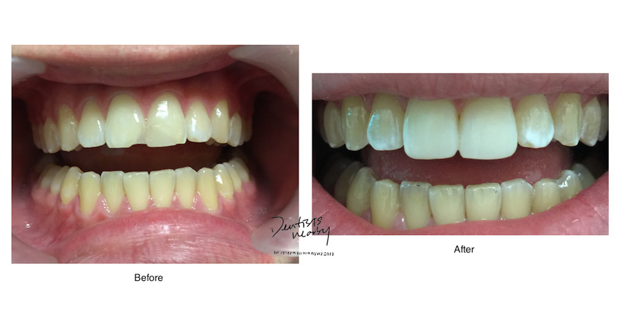 Jaya-dental-surgery-composite-bonding-dental-treatment11
