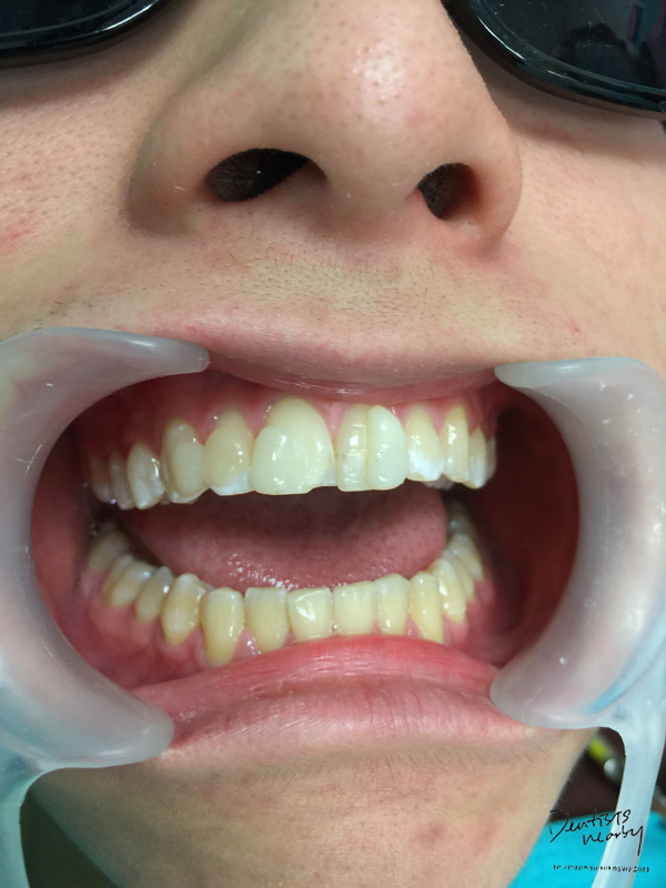 Jaya-dental-surgery-composite-bonding-dental-treatment2