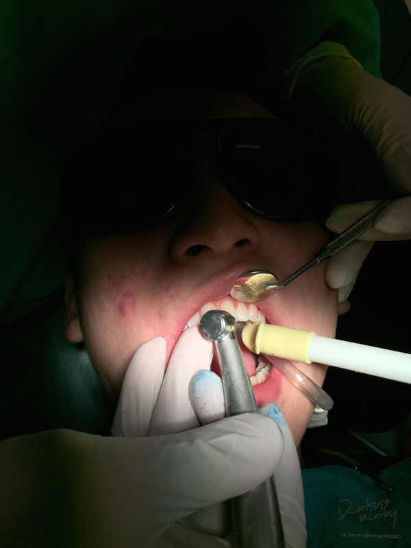 Jaya-dental-surgery-composite-bonding-dental-treatment3