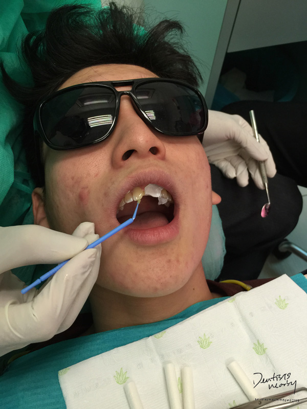 Jaya-dental-surgery-composite-bonding-dental-treatment5