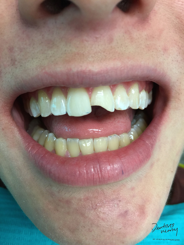 Jaya-dental-surgery-composite-bonding-dental-treatment6