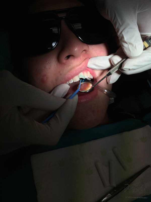 Jaya-dental-surgery-composite-bonding-dental-treatment7