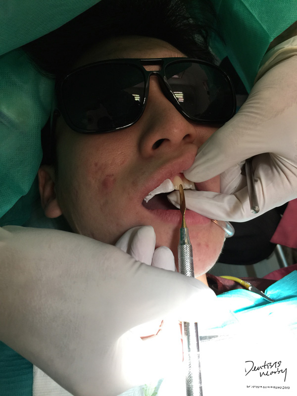 Jaya-dental-surgery-composite-bonding-dental-treatment8