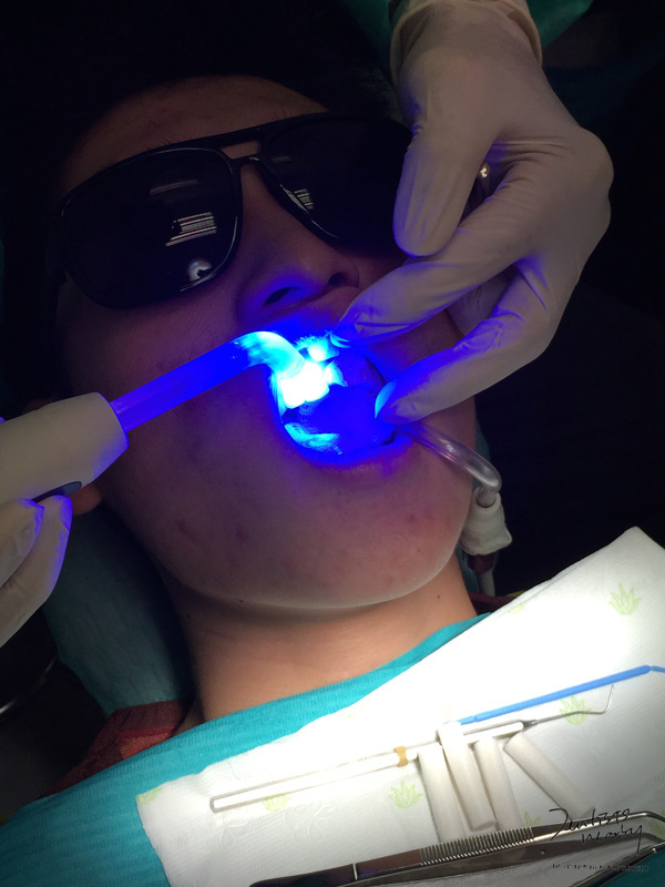 Jaya-dental-surgery-composite-bonding-dental-treatment9