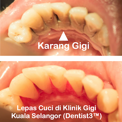 karang-gigi-small