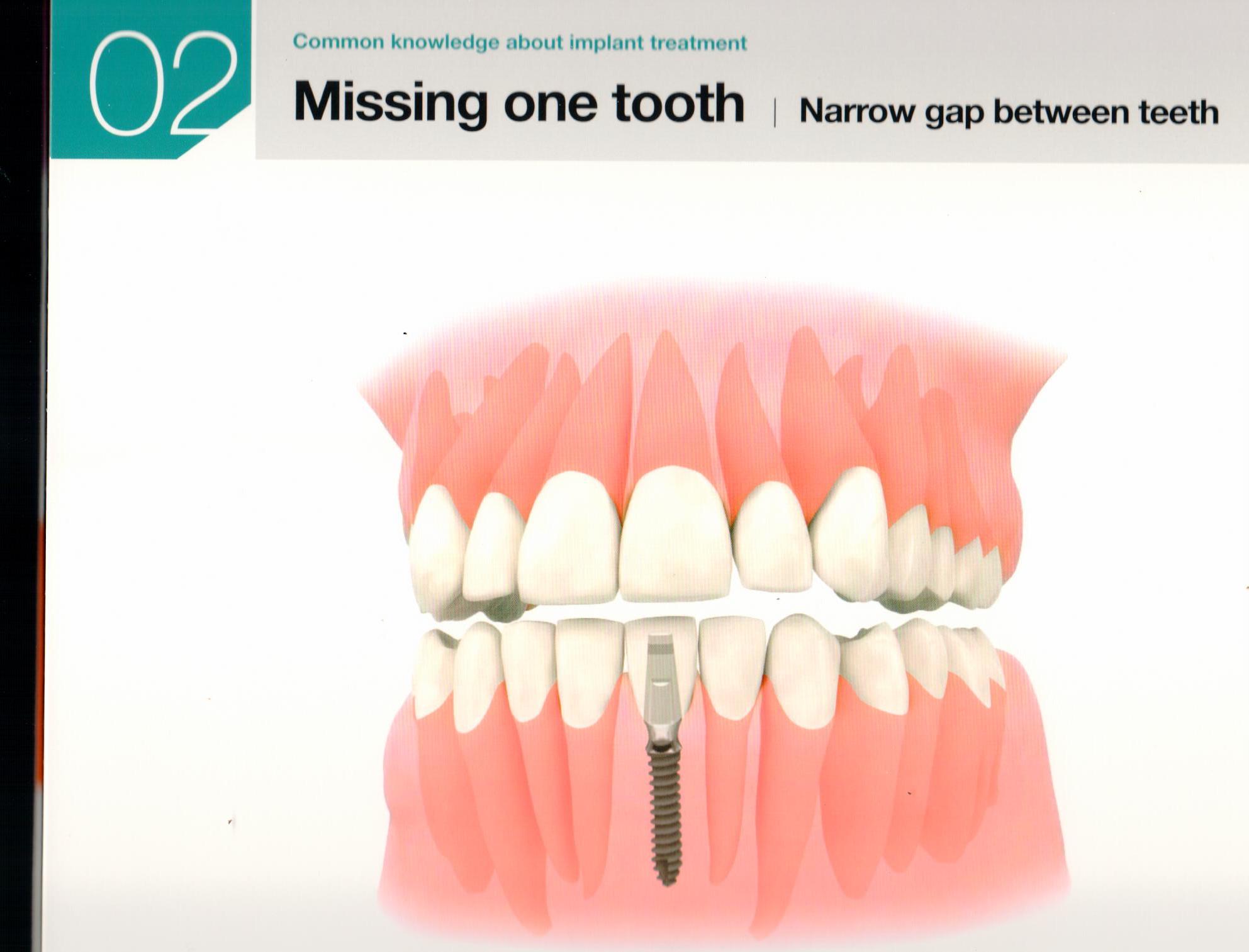 Cavity Prevention: The #1 Habit Dentists Don'T Tell You - eg6nly7