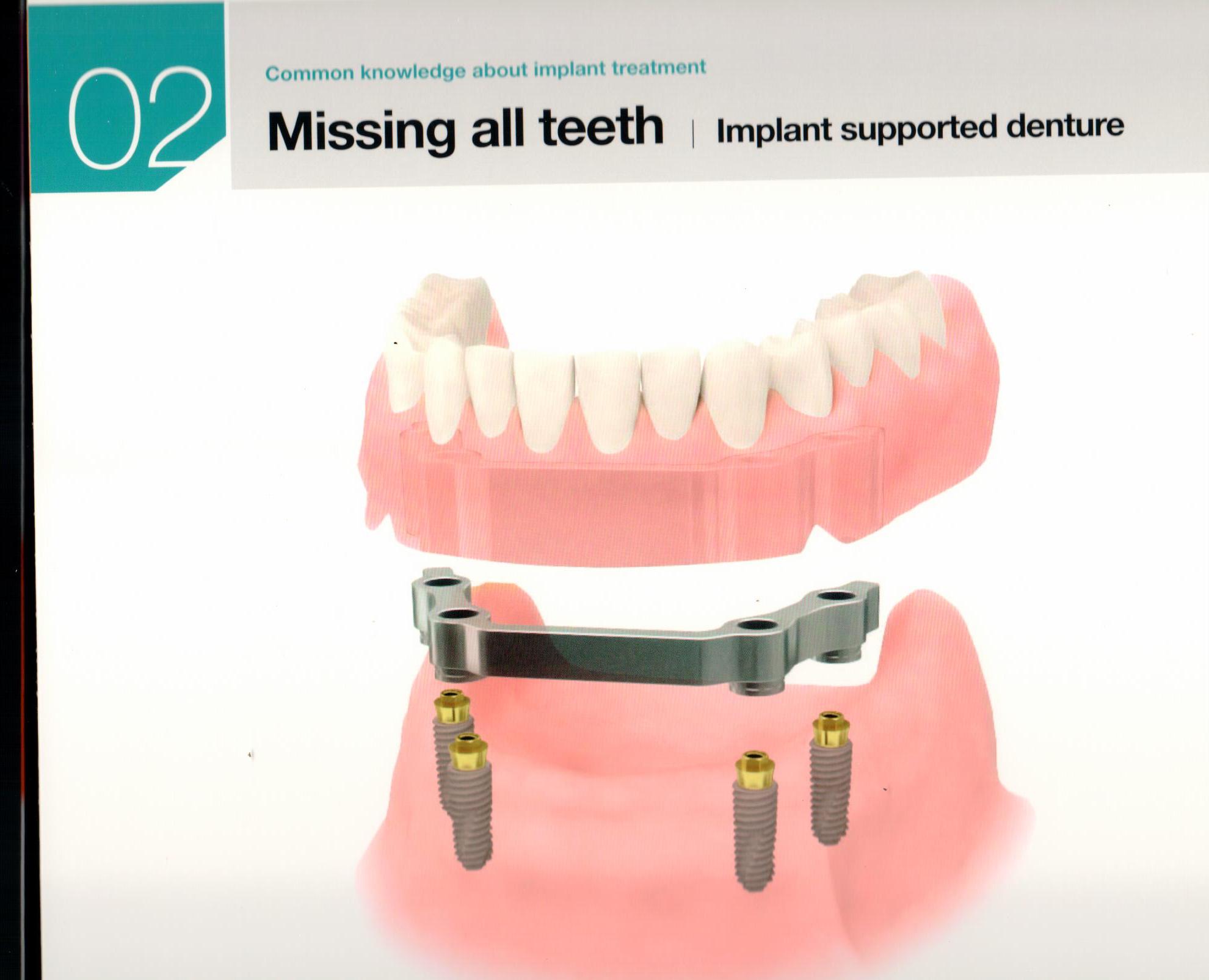 Implant, The Second Permanent Teeth (Osstem®) Dental Clinics