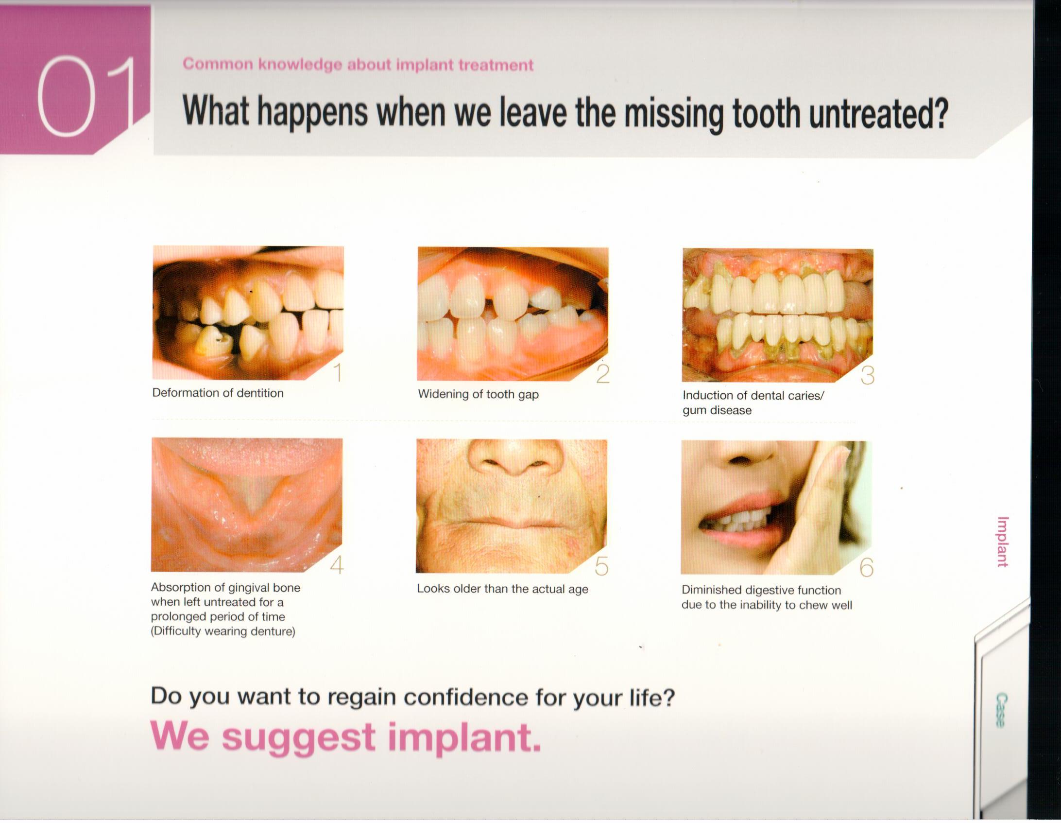 Implant, The Second Permanent Teeth (Osstem®)  Dental 