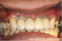 dental-implant-lee-soon-boon-dentistsnearby3
