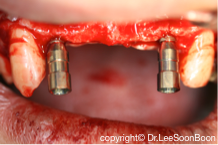 dental-implant-lee-soon-boon-dentistsnearby5