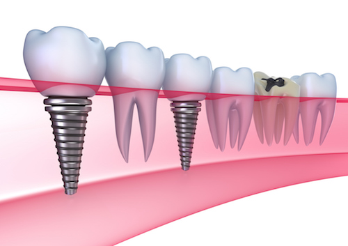 dental-implants-city-dental-dentistsnearby