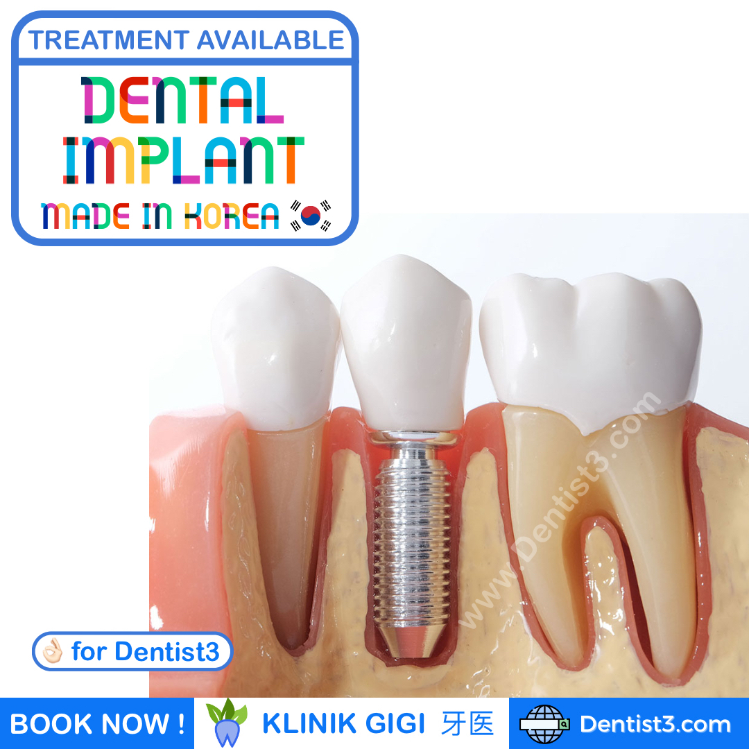 Dental Implant Cost in Malaysia Dental Clinics, Dentists, Klinik Gigi & 牙医 in Malaysia