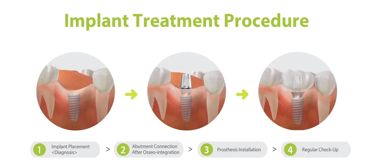 Best Dental Implant In Malaysia Dental Clinics, Dentists, Klinik Gigi