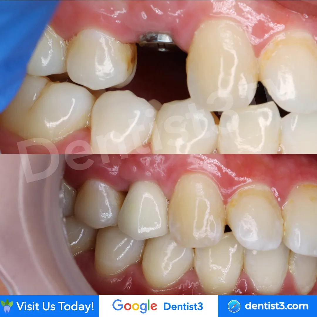 Harga Implan Gigi Malaysia Dental Clinics, Dentists, Klinik Gigi & 牙医