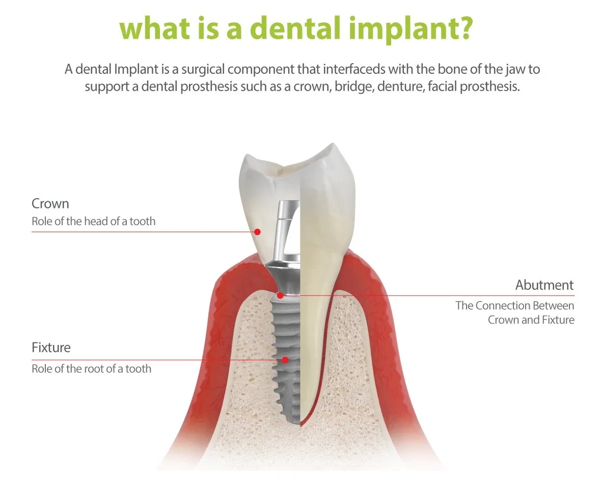Best Quality Dental Implant Malaysia Dental Clinics, Dentists, Klinik