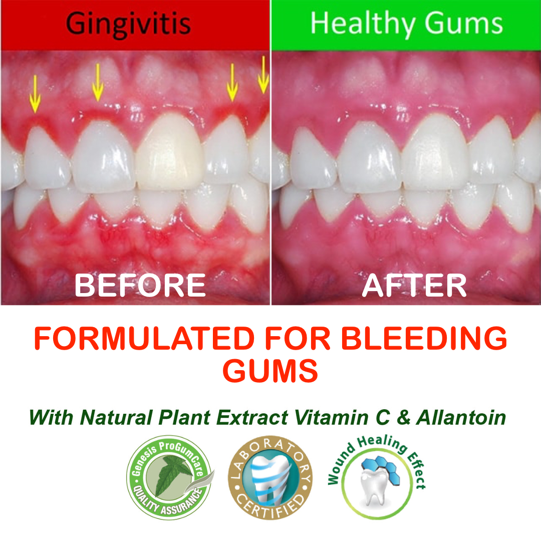 New Toothpaste For Gum Care Genesis ProGumCare Natural & Healthy