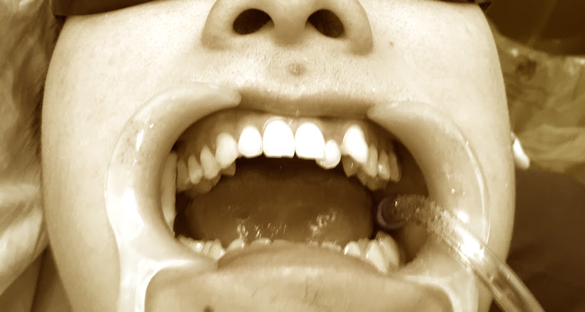 Mouth-prop-dentistryJPG