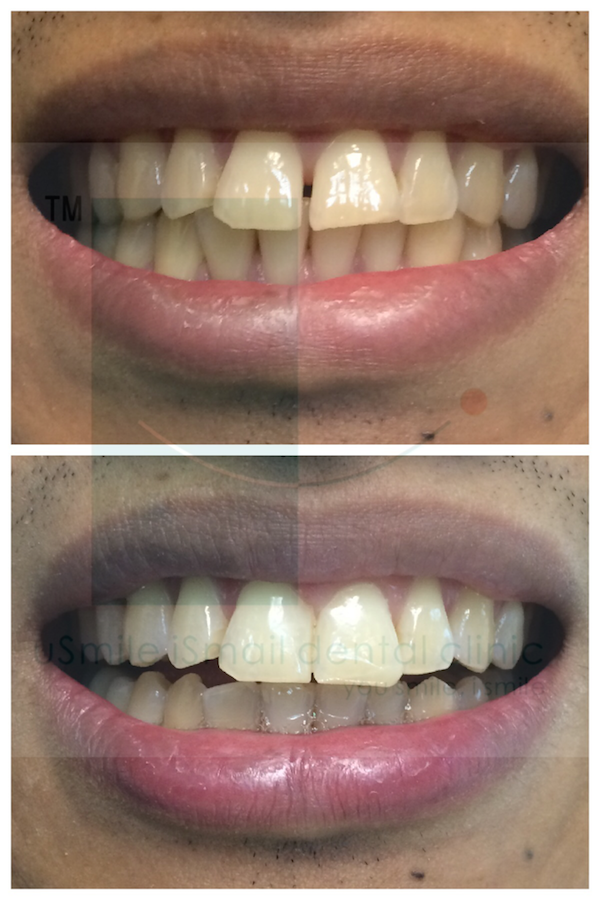 usmile-ismile-aesthetic-dentistry-before-after